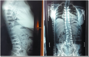 Imagen de columna con prótesis y tornillos.