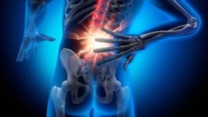 Hernia discal