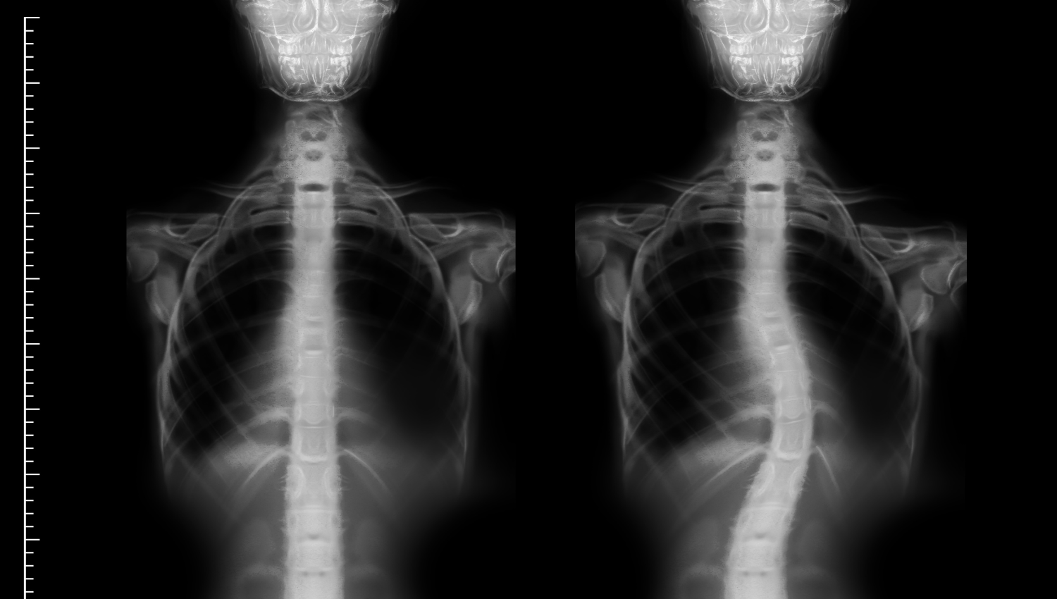 escoliosis
